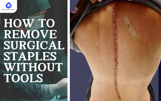 How to Remove Surgical Staples Without Tool: Safe Tips